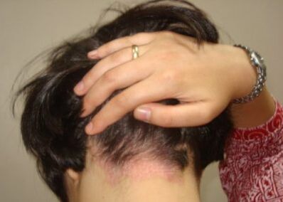 Psoriasis