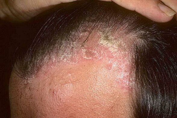 Symptoms of psoriasis