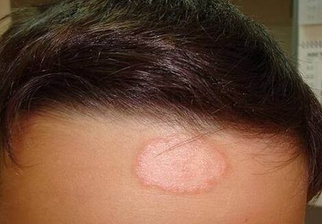 Psoriasis points
