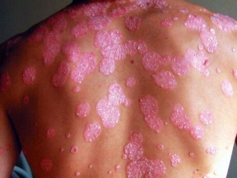 psoriasis
