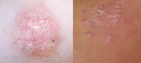 Psoriasis in the early stages